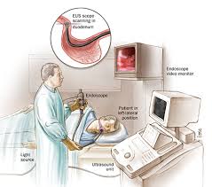 Endoscopic Ultrasound Equipment